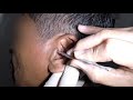Removing Man&#39;s MASSIVE Earwax | Gotta See This!