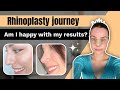 My septoplasty  rhinoplasty transformation the yearlong journey revealed