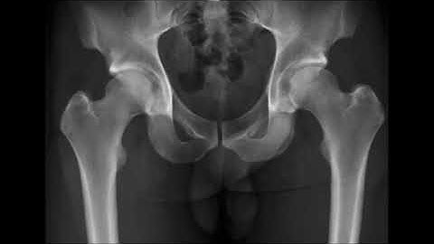 hip diagnostic needle arthroscopy