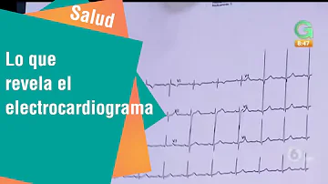 ¿Revela un ECG todos los problemas cardíacos?