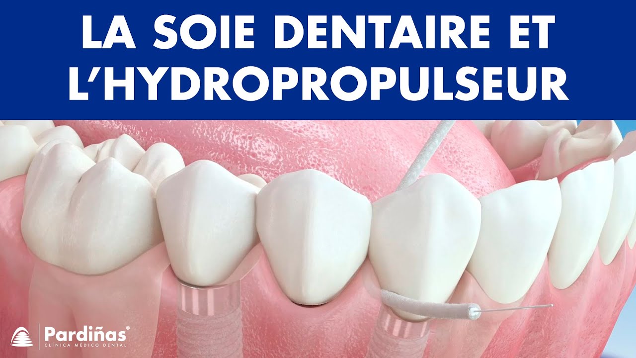 Soie dentaire et l’hydropropulseur — Méthodes de nettoyages des implants ©