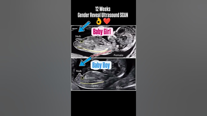 12 Week's Gender Reveal Ultrasound Scan #genderpredictions #genderdetermination #genderreveal