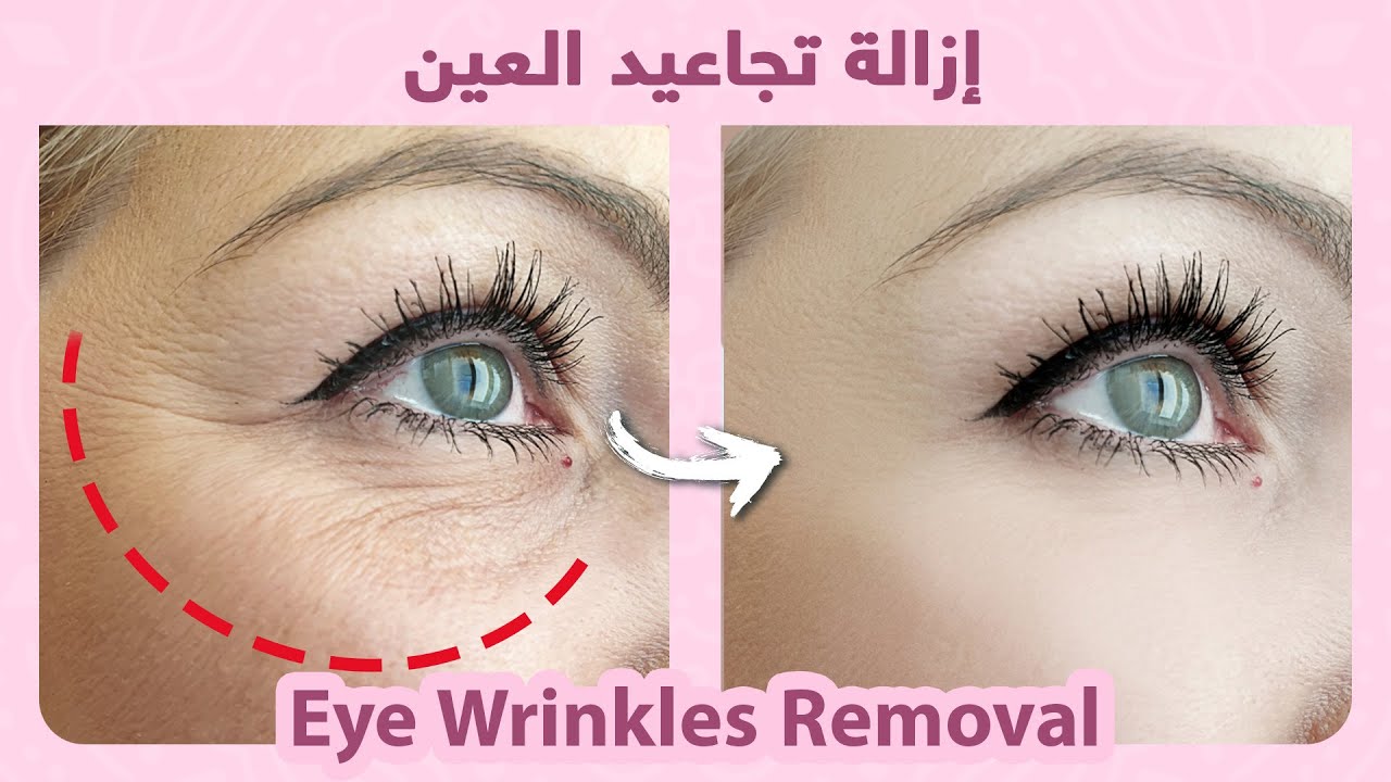 How to naturally get rid of eye wrinkles - YouTube