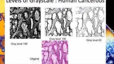 Fractal Dimension Analysis to Predict Cancer: Madhurima Das