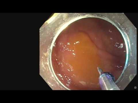 Management of Complications of Endoscopic Mucosal Resection