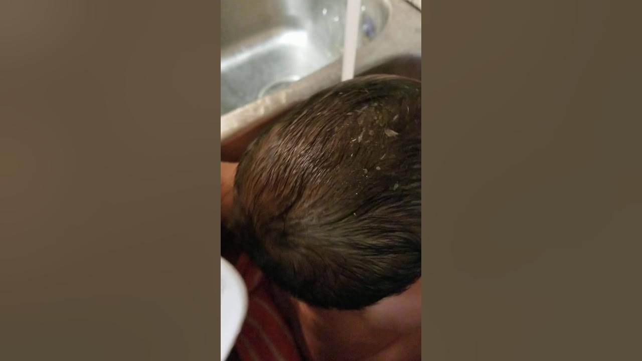 Baby Cradle cap Removal YouTube