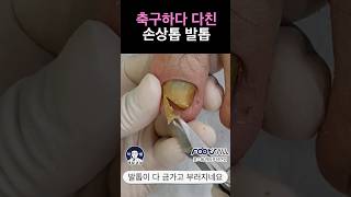 축구하다 많이 다친 변형된 발톱 제거 관리 #두꺼운발톱제거