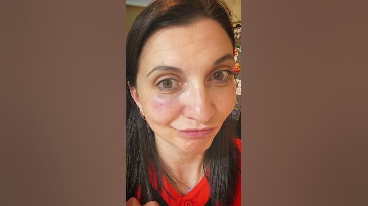 My Wild Pitch Gives Mom a Black Eye. Sorry Mom! #shorts