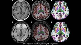 Automated Brain Volumetry in Patients With Memory Impairment