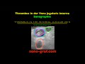 Sonographie - Thrombus in der Vena jugularis interna