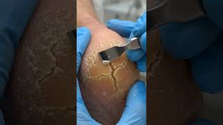 Heel Callus Removal ASMR 😳💀 Satisfying Cracked Skin Transformation #FootCare #HeelRepair #ASMR