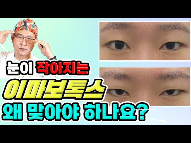 비대칭 눈, 짝짝이눈 고민? 이마보톡스, 너 뭔데?