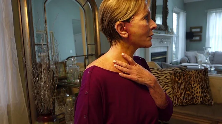 Paula 1 week after her Lower Face/Neck Lift: Min S...
