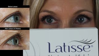 My Experience with Latisse | Before & After