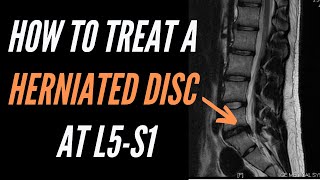 How To Treat A Herniated Disc At L5 S1