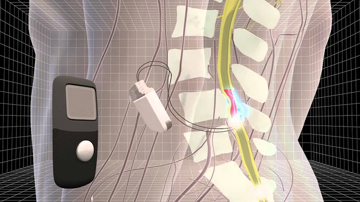 Innovative technology offers new hope for paraplegics