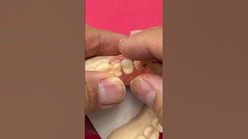 Premolar Nesbit Partial @EnvisiontecMain #envisiontec