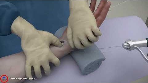 Surgery for distal radius fracture surgery | Osteotomy | #3d #surgery