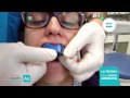 INVISALIGN - Tecnica della doppia impronta