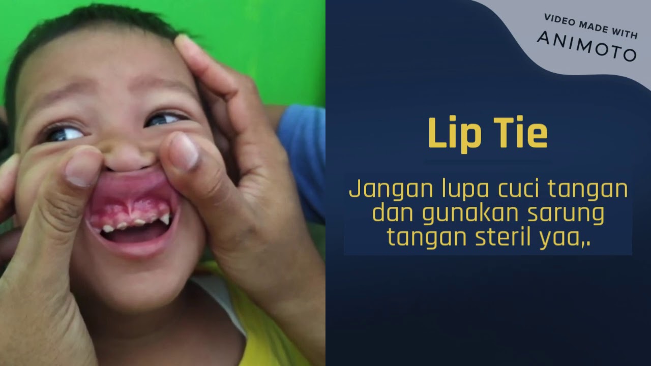 Cara Memeriksa Lip Tie Dan Tongue Tie Anak Youtube