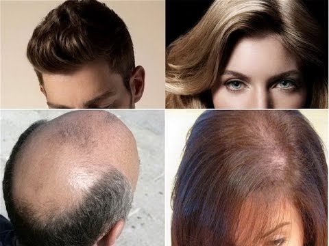 types-of-hair-loss-|-alopecia-areata-|-androgenetic-alopecia-|-minoxidil-5%-hair-fall-solution