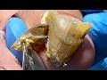 Amazing! Those Toenails Are Terrible!【Xue Yidao】