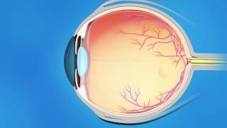 Mini Filtration Implants for Glaucoma