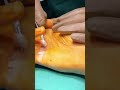 Ulnar nerve claw hand deformity #drdinesh #ulnarnerve #clawhanddeformity #orthopedicsurgeon