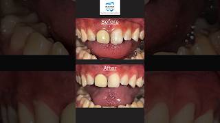 Dental Fluorosis Management With Enamel Microabrasion Using Opalustre By Ultradent