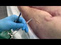 Point de suture inverse