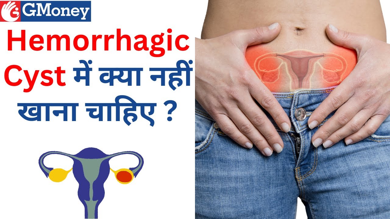 Hemorrhagic Cyst क्या है ? [hemorrhagic cyst in hindi] - YouTube