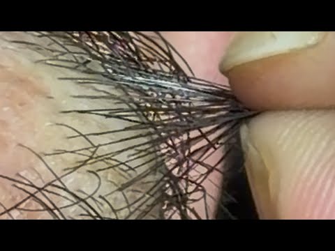 #barber 💈 #barbershop #barberlove #barish #ingrownhair #oddlysatisfying #oddlysatisfyingvideo