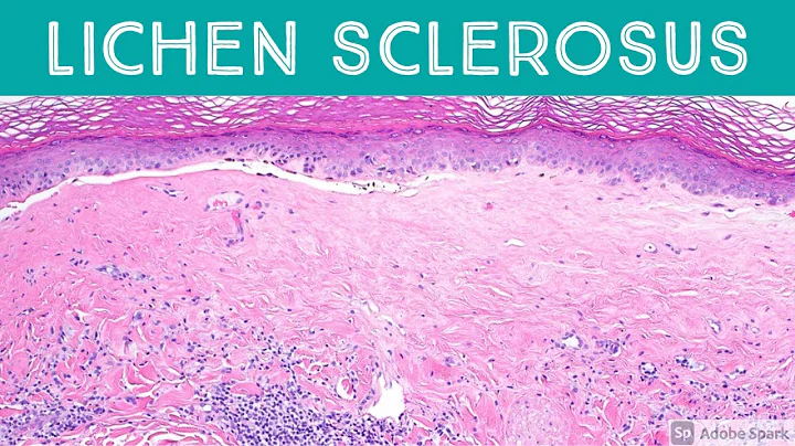 Lichen Sclerosus et atrophicus: Inflammatory Dermpath Basics for Dermatology & Pathology