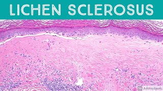 Lichen Sclerosus et atrophicus: Inflammatory Dermpath Basics for Dermatology & Pathology screenshot 5