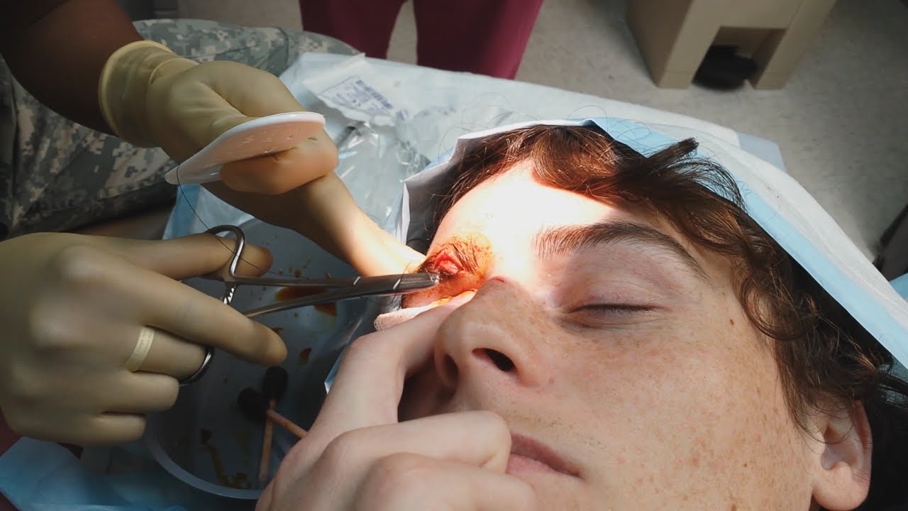 snorkeling in boracay First Time Getting Stitches (Warning Graphic) | DALLMYD