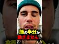 ジャスティンビーバーの顔の半分が動かなくなった理由