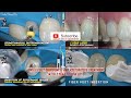 One visit endodontic fiber post composite resin clinical case 1 year follow up bone regeneration