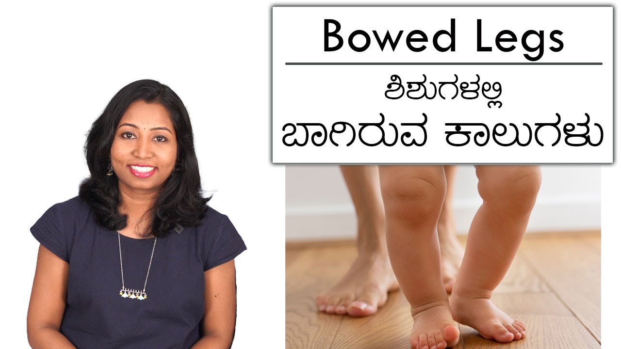ಶಿಶುಗಳಲ್ಲಿ ಬಾಗಿರುವ ಕಾಲಿನ ಸಮಸ್ಯೆ | Bowed Legs in Babies