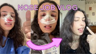 NOSE JOB and DEVIATED SEPTUM VLOG... my septorhinoplasty recovery + tips by Asia Paoloni 8,683 views 1 year ago 15 minutes