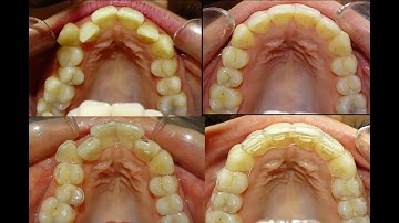 Expansion with Smilers Aligners www.smilers.com