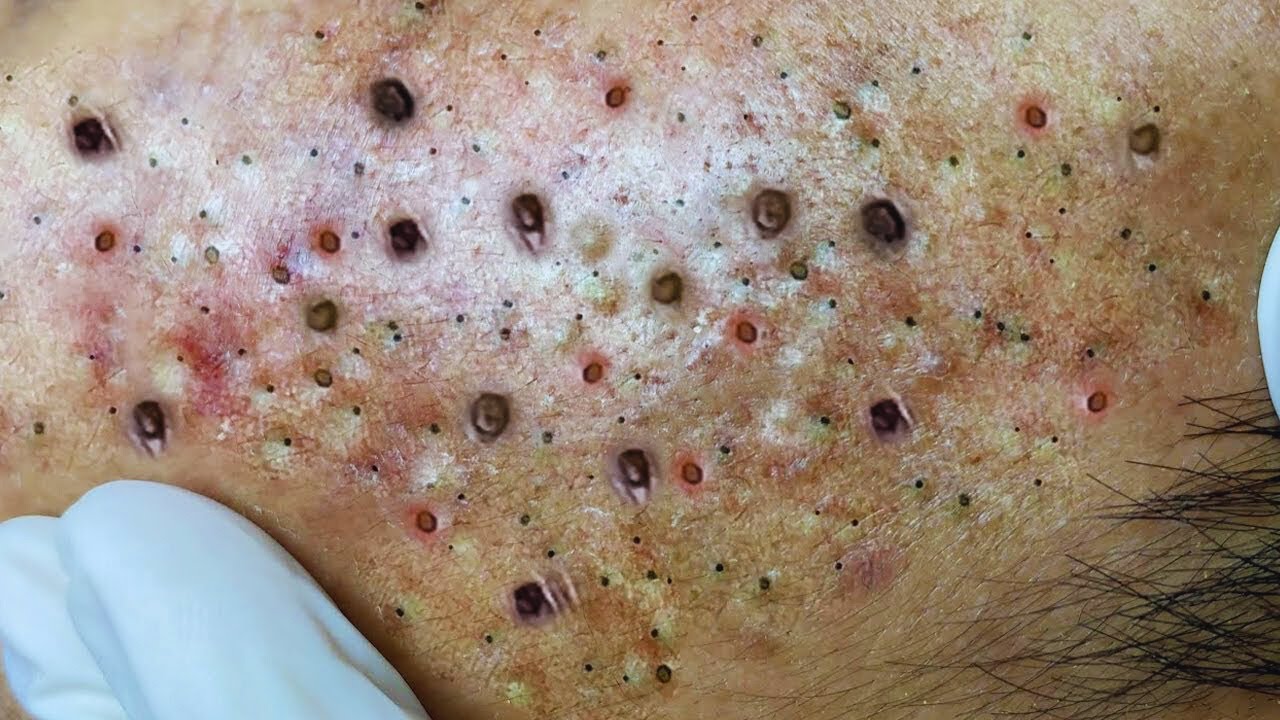 😱 Extreme Blackheads Removal on Face – Satisfying Pimple Popping - YouTube