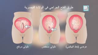 Alyaa Gad - C-Section الولادة القيصرية