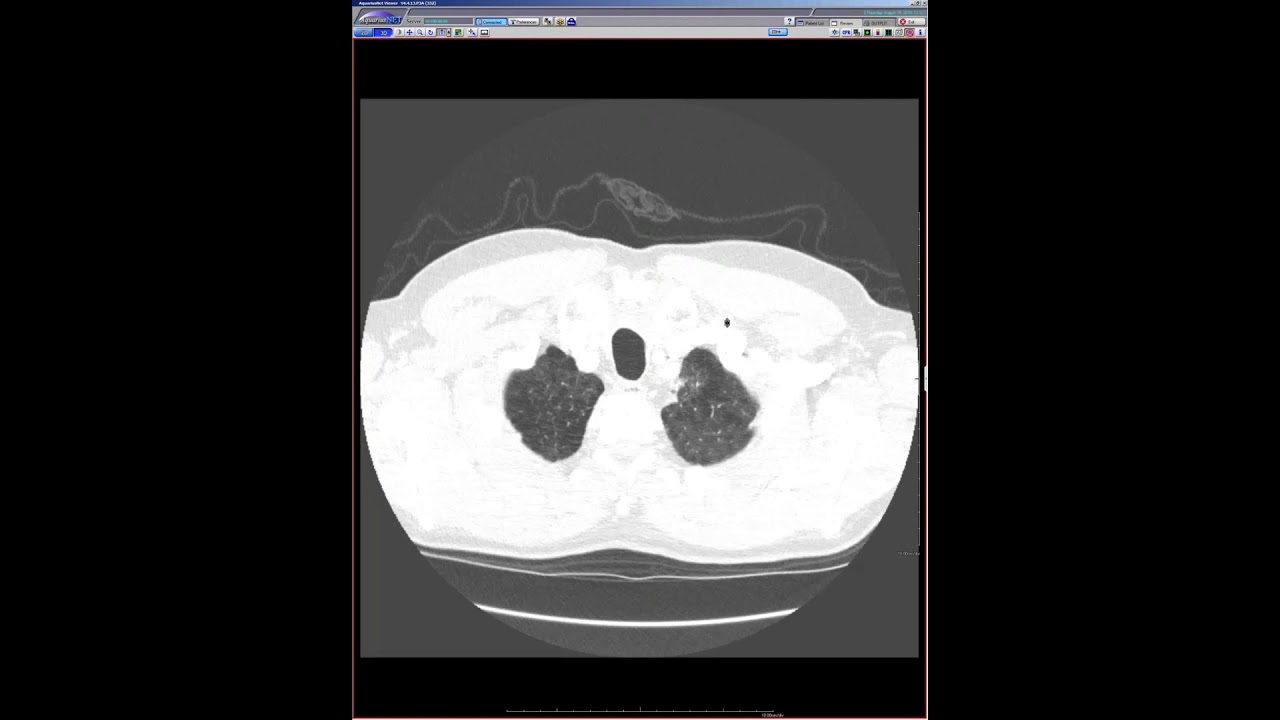 STR Cardiothoracic Case Webinar 8/15/2019 STR Cardiothoracic Case Webinar 8/15/2019