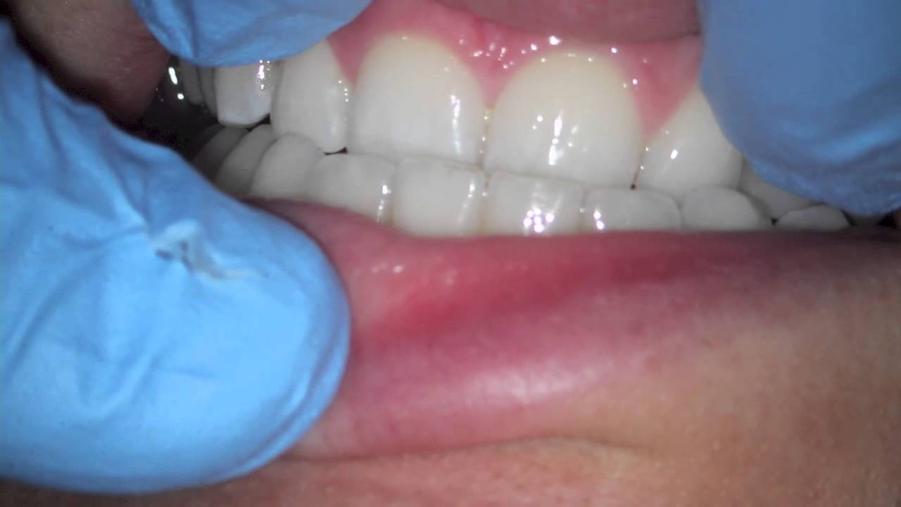 loose tooth and recession from biting forces (occlusal trauma) YouTube