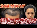 【M字ハゲ】20代の薄毛に悩む青年に植毛美容師が現実を伝えました。