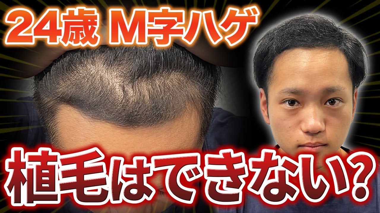 M-shaped baldness] A hair transplant beautician explains the