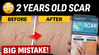 Silicone Scar Sheets Review – Do They Really Work?