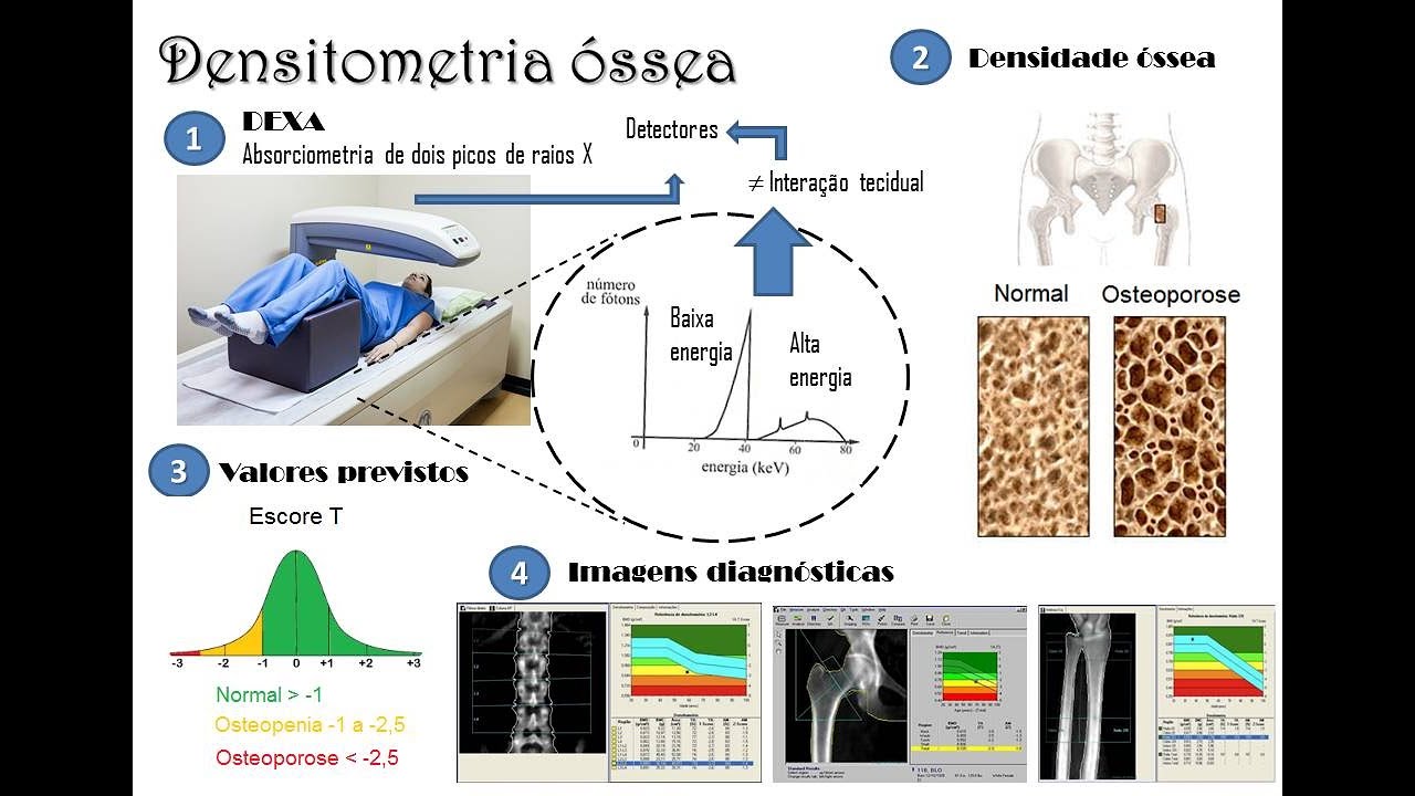 Densitometria óssea - Tópicos gerais