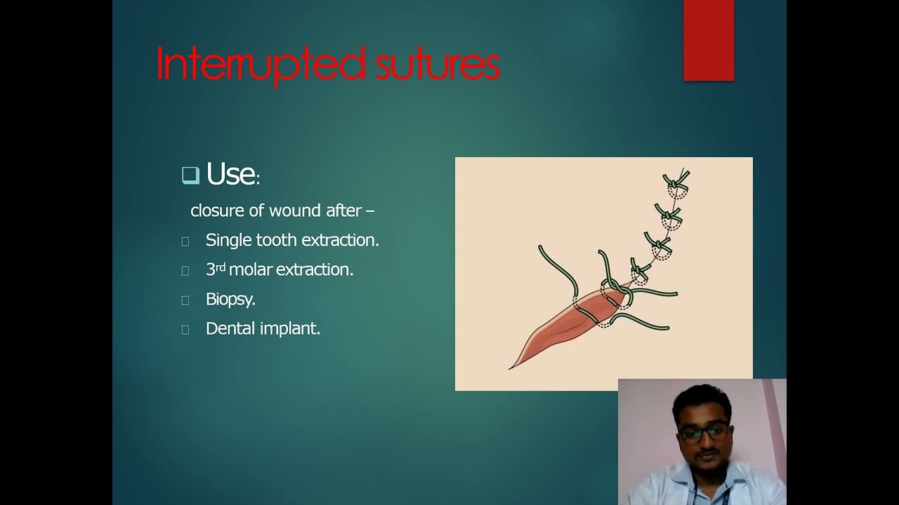 Suture Materials & Suture Techniq | Oral Maxillofacial Surgery | Dr. Arun | SBDCH
