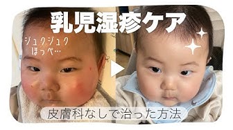 乳児湿疹 Youtube
